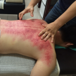 treatment-4